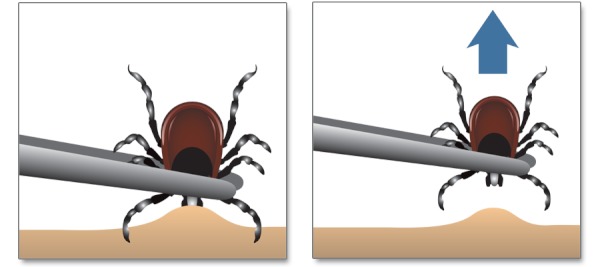 indepartarea căpuşei Cum Ne Protejăm Copiii de Înţepăturile de Insecte indepartarea căpuşei Cum Ne Protejăm Copiii de Înţepăturile de Insecte